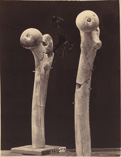 Specimens of Gunshot Fractures of the Femur, c. 1867.