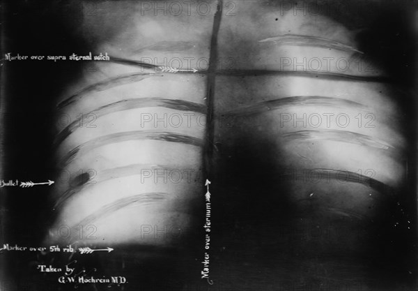 X-Ray of Roosevelt [shows bullet], 1912. Creator: Bain News Service.