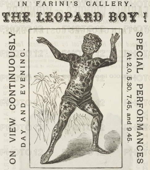 The Leopard Boy! in Farini's Gallery, 1881. 'On View Continuously, Day and Evening. Spotted black, white and yellow from head to foot'. Child with some sort of skin condition, 'performing' in Farini's World of Wonders Gallery at the Royal Aquarium in London. Showmanship was a hard business. People and animals with unusual characteristics were ruthlessly exploited and there was little care for them once they lost their popularity with the audience.
