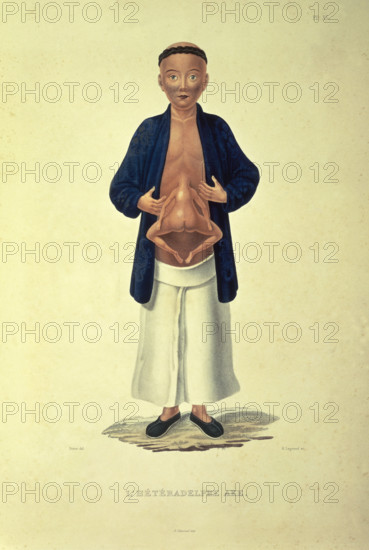 L'heteradelphe Ake, c1824-c1826. A human figure with a body growing from the stomach. The term heteradelph meant double-bodied. From "Journal de la navigation autour du globe de la fregate la Thetis et de la corvette l'Esperance" (Journal of the navigation around the globe of the frigate Thetis and the corvette Esperance) by Hyacinthe de Bougainville.