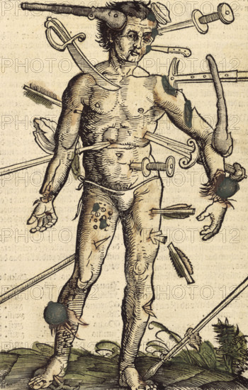 The wound man, 1517. German surgeon Hans von Gersdorff wrote a book with instructions for procedures such as amputation. It was illustrated with woodcuts attributed to Hans Wechtlin. From "Feldtbuch der Wundarztney" (Field book of surgery) by Hans Gersdorff.