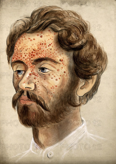 Head of a man with a severe disease affecting his face, (18)60. Creator: Christopher D'Alton.