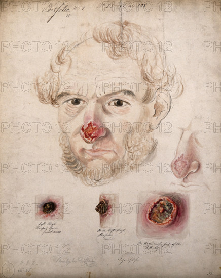 Head of a man with a severe disease affecting his nose; a detail of the nose..., 1800-1899. Creator: Christopher D'Alton.