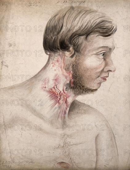 Head and chest of a man with a disease affecting his neck, seen in profile, 1856. Creator: Christopher D'Alton.