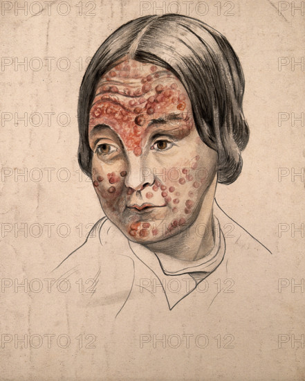 Head of a woman with a severe disease affecting her face, (18)58. Creator: Christopher D'Alton.