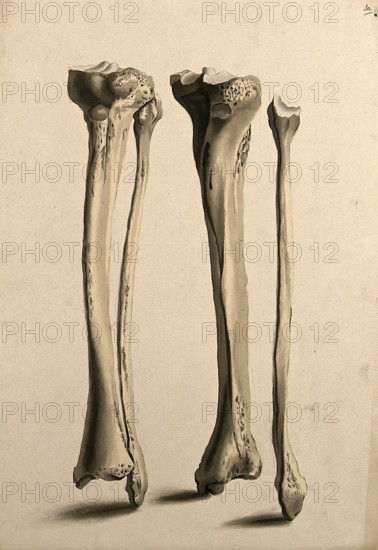 Tibia and fibula bones, 1830-1835. Creator: Unknown.