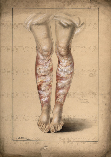 Diseased skin on the legs of a man suffering from psoriasis, 1873. Creator: Christopher D'Alton.
