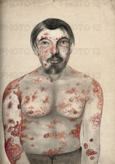 Diseased tissue on the face, shoulders arms and torso of a man suffering from psoriasis..., (18)66. Creator: Christopher D'Alton.