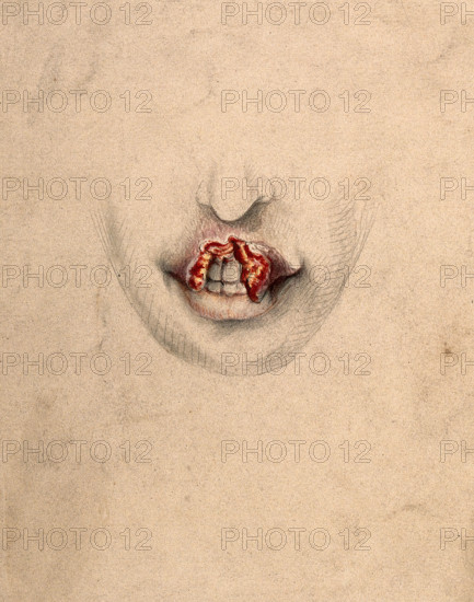 Severely diseased tissue on the upper lip of a woman suffering from tertiary syphilis, 1869. Creator: Christopher D'Alton.
