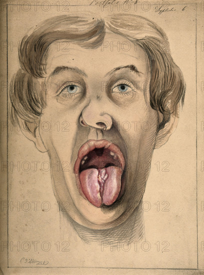 The face of a man suffering from syphilis, shown with mouth open wide, displaying areas of..., 1869. Creator: Christopher D'Alton.
