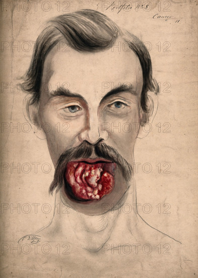 The face of a man suffering from cancer of the tongue, showing severely diseased tissue..., 1867. Creator: Christopher D'Alton.