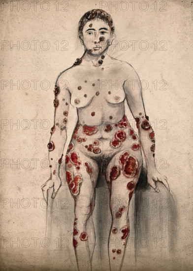 A woman suffering from open sores and abcesses on her face and entire body, 1867. Creator: Christopher D'Alton.