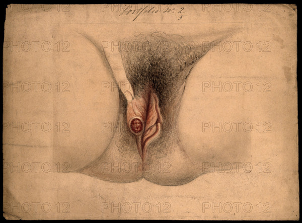 Female genitalia held open by a finger to show an area of diseased tissue, (18)66. Creator: Christopher D'Alton.