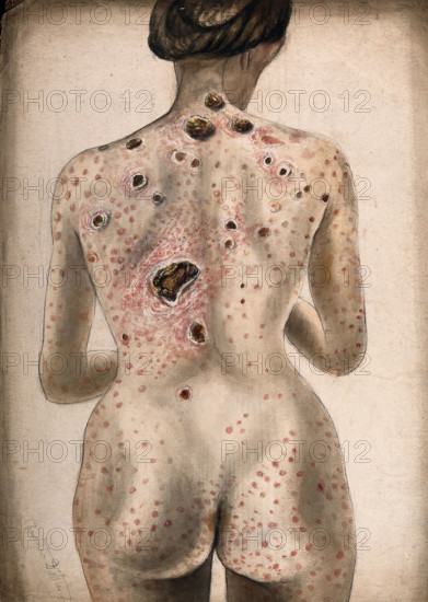 The back, buttocks and arms of a woman, displaying areas of diseased tissue..., (1840/1870?). Creator: Christopher D'Alton.