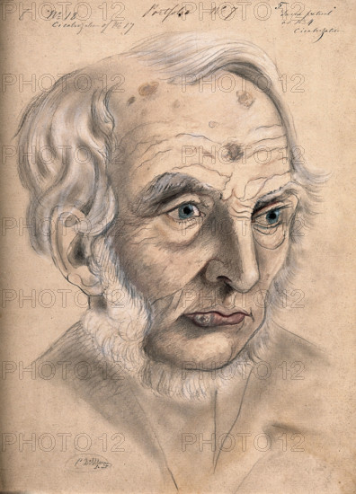 A man suffering from chancre of the lip, displaying scar tissue on his lower lip, forehead..., 1867. Creator: Christopher D'Alton.