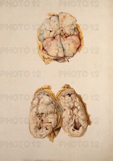 Two diseased parts of the body. Creator: Unknown.