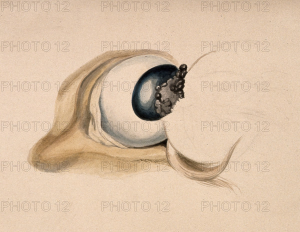 A diseased eye. Creator: Unknown.