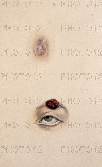 A section of a child's diseased forehead (detail); and a child's diseased eyebrow..., 1829. Creator: Unknown.