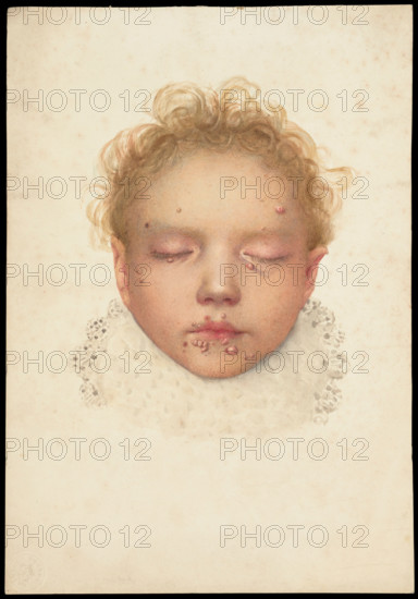 Head of a child with closed eyes and skin disease on the face, 1892. Creator: Unknown.