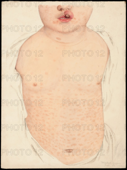 A boy with a congenital deformity of the mouth and a rash on the trunk, Feb 16th 1901. Creator: Mabel Green.