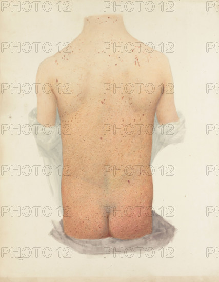 Back of a boy with skin disease, 1891. Creator: W Toogood Hill.