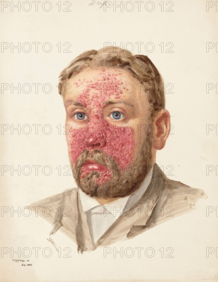 The head of a man with skin disease, July 1889. Creator: W Toogood Hill.