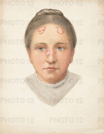 The head of a young woman with loss of skin on her forehead and nose, (1900?). Creator: Jonathan Hutchinson.