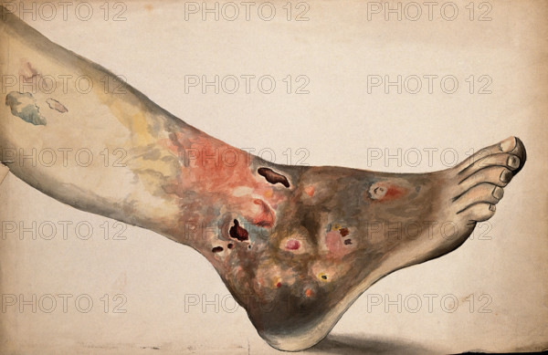 A diseased foot and lower leg. Creator: Unknown.