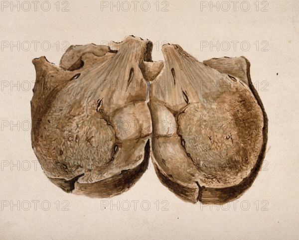 Section through polypus uteri, 1831. Creator: Unknown.