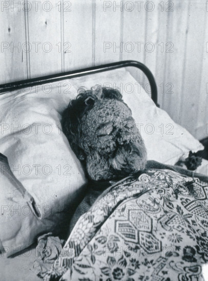 Gloucester smallpox epidemic, 1896: George Steel as a smallpox patient, 1896. Creator: HCF of Gloucester.
