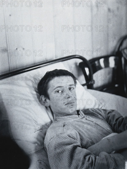 Gloucester smallpox epidemic, 1896: J Mawson, a smallpox patient, 1896. Creator: HCF of Gloucester.