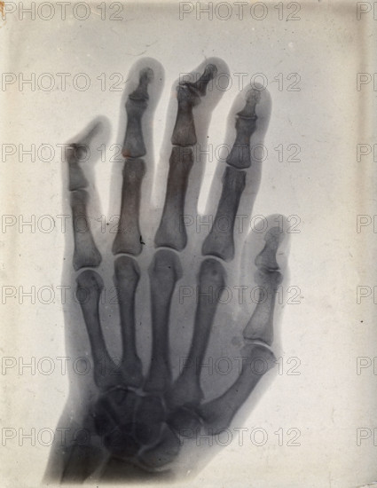 The bones of a hand, viewed through x-ray, 1895.