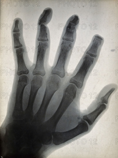 The bones of a hand, with the tip of the index finger missing, viewed through x-ray, 1896.