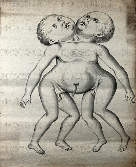 Male conjoined twins joined at the neck and chest; anterior view, 1900. Creator: Unknown.