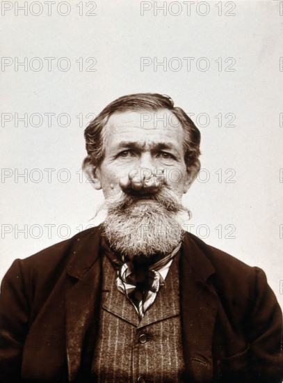 A patient of Léon Desguin, before operation, c1890s. Creator: Unknown.