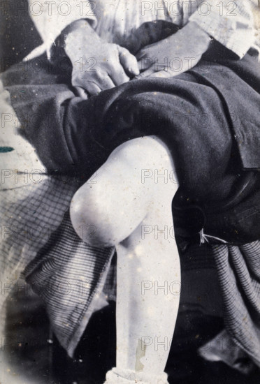 Friern Hospital, London: the knee of a seated person, with a large growth,  1890-1910. Creator: Unknown.