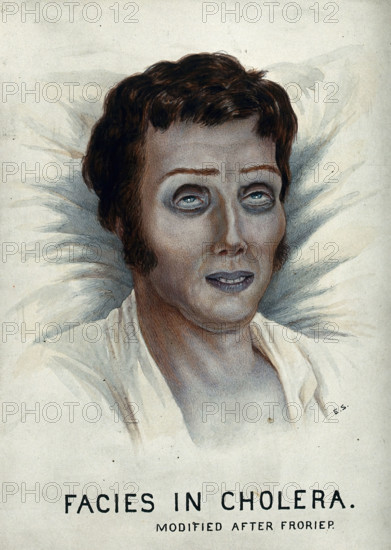 A cholera victim with a typical facial appearance, 1920-1950. Creator: Unknown.