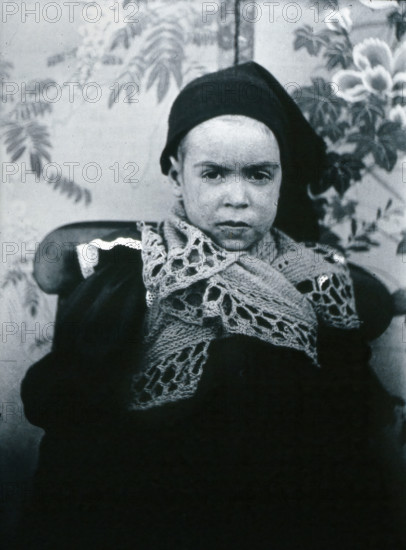 Gloucester smallpox epidemic, 1896: a child of the Beard family, as a convalescent smallpox..., 1896 Creators: HCF of Gloucester, Unknown.