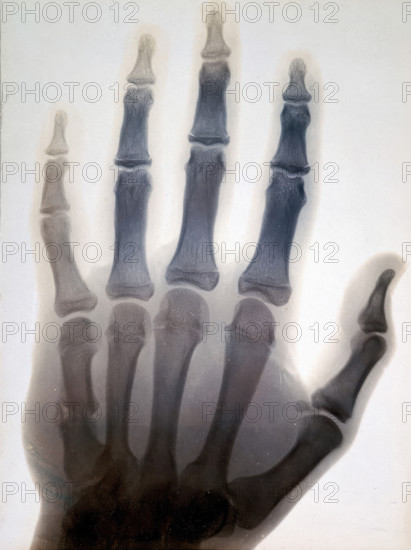 Sir Gervas Powell Glyn, 6th Bart: radiograph of his hand, 1896. Creator: Sir GP Glyn.