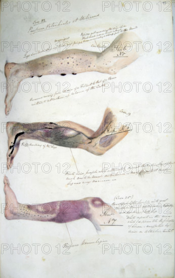 The effects of scurvy, February 1841. Creator: Henry Walsh Mahon.