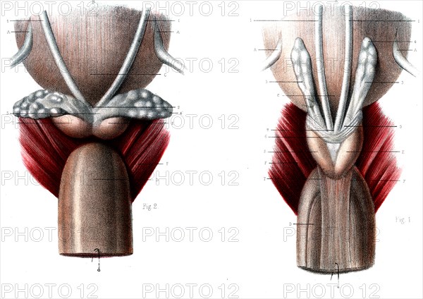 Anatomie de la prostate
Fig 1 : vésicules séminales en place
Fig 2 : vésicules injectées au mercure et séparées de la vessie
1866