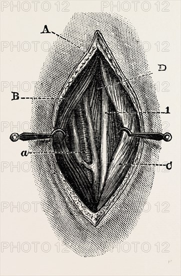 ligature, medical equipment, surgical instrument, history of medicine