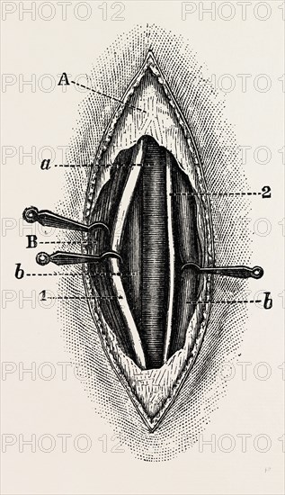 ligature of the right finger, medical equipment, surgical instrument, history of medicine