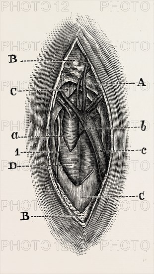 ligature, medical equipment, surgical instrument, history of medicine