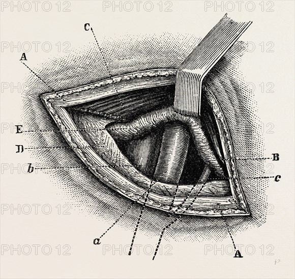 ligature of right external iliac artery, medical equipment, surgical instrument, history of medicine