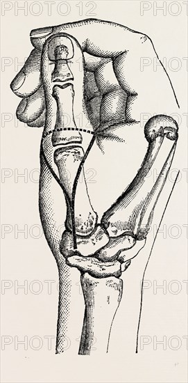 disarticulation, medical equipment, surgical instrument, history of medicine