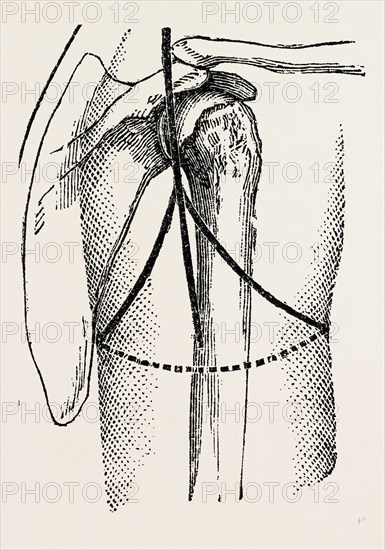 disaetictjlation at the posterior part of the oval, medical equipment, surgical instrument, history of medicine