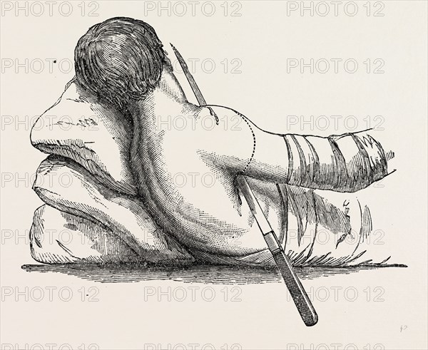 amputation at the shoulder-joint by transfixion, from fergusson's, medical equipment, surgical instrument, history of medicine