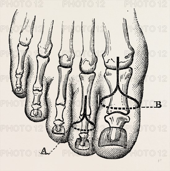 disarticulation, medical equipment, surgical instrument, history of medicine