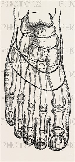 chopart's amputation, medical equipment, surgical instrument, history of medicine